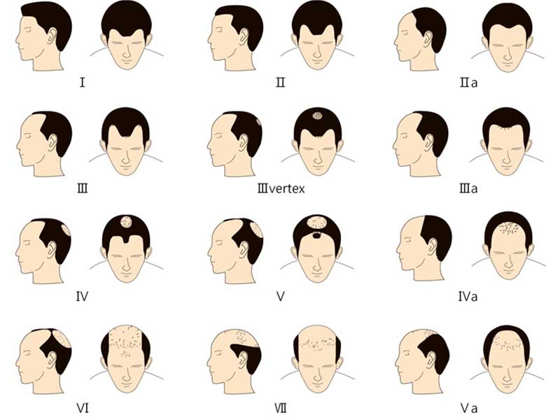 Why do men's hair shed