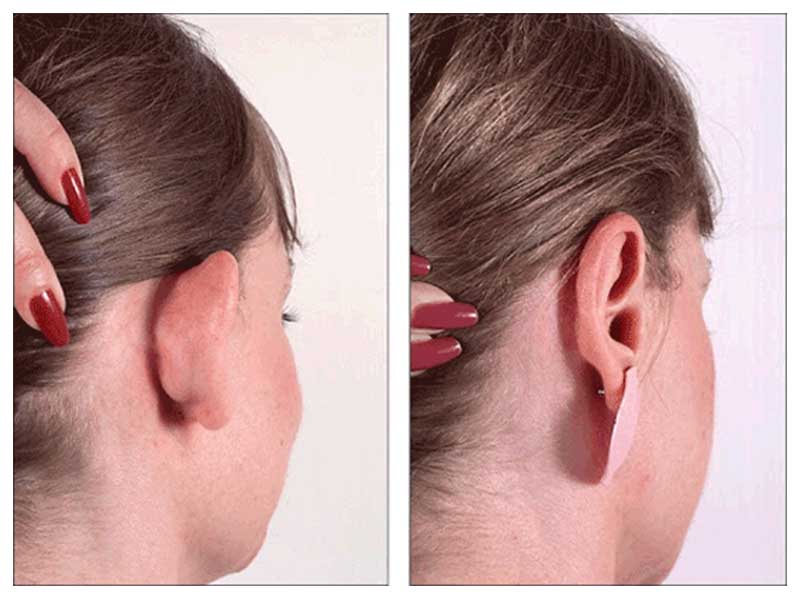 جراحی زیبایی گوش یا اتوپلاستی