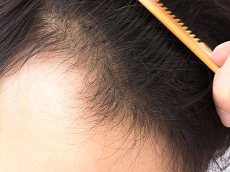 مزوتراپی مو برای چه افرادی مناسب است؟